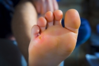 Corns or Calluses?