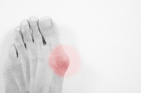 Causes and Finding Relief for Bunions