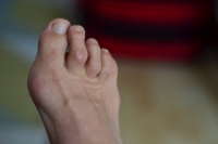 Hammertoe Deformity and Its Common Causes